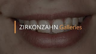 Prettau® veneers with PlaneSystem® and Face Hunter  ZirkonzahnGalleries [upl. by Murton]