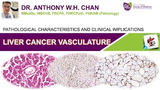 Liver Cancer Vasculature  Pathological Characteristics and Clinical Implications [upl. by Nohsed]