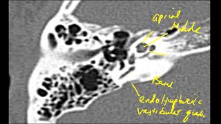 Anatomy of the Internal Auditory Canal  Inner Ear MRI  MRI Online [upl. by Jannery]