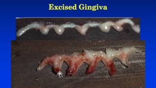 Module 8 GingivectomyGingivoplasty [upl. by Aihsoj]