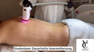 Diodenlaser Behandlung Dauerhafte Haarentfernung Rücken [upl. by Nimar]