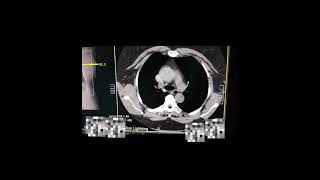 Angiotomografia das Artérias Pulmonares  Protocolo TEP Canon 16 canais [upl. by Strage]