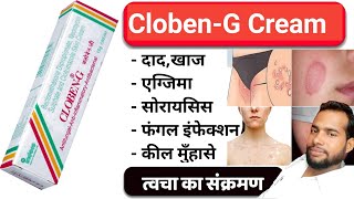 Cloben G Cream  Cloben G Cream Uses in Hindi  त्वचा का संक्रमण  fungal infection [upl. by Vanda]