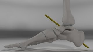 Over Pronation amp Supination Motion Biomechanics of the Subtalar Joint Explained [upl. by Ellenhoj969]