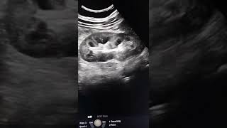 36 year male co pain in both flank and swelling of both legs and face since 2 month ultrasound [upl. by Adnol529]