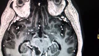 HAEMOSIDERIN LEVEL MARK INTRACAVITARY BLEEDING IN ADULT ASTROCYTOMA CEREBELLAR [upl. by Sevart]