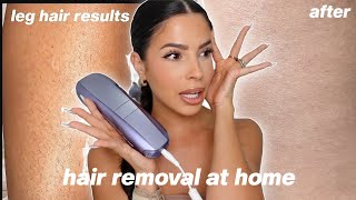 I TRIED LASER HAIR REMOVAL AT HOME this is what happened [upl. by Hollister]