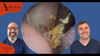 EAR WAX REMOVALS USING CROCODILE FORCEPS JOBSON HORNE amp MICROSUCTION  EP841 [upl. by James]