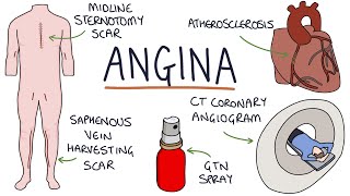 Understanding Angina Visual Explanation for Students [upl. by Barcot520]