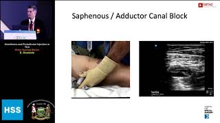 Anesthesia and Periarticular Injection in TKA Motor Sparing Blocks  Dr E Goytizolo [upl. by Salb]