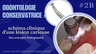 odontologie conservatrice  schéma clinique dune lésion carieuse part2 [upl. by Yeta]