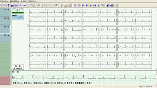 Dynamic ECG analysis software [upl. by Henleigh649]