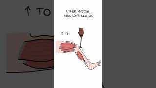 Motor lesions [upl. by Leiva837]