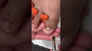 Toenail reconstruction tutorial 💅🏿 nails nailstutorial viralshorts2024 fypyoutube fypシ゚viral [upl. by Ecirehc]