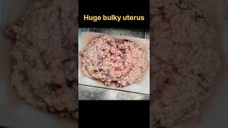 Huge fibroid uterus with secondary changes specimen for histopathology  histopathology [upl. by Yorgerg156]