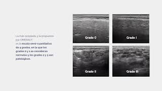 Caso clínico Ecografía de glándula salival en el síndrome de Sjögren [upl. by Urdna77]