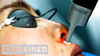 EXPLAINED PicoSure Pro Laser  London [upl. by Mitchael94]