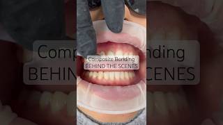 Composite bonding behind the scenes with Dr Sonnie 🙌 compositebonding newsmile veneers viral [upl. by Stedt]