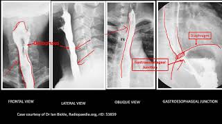 Abdominal XRay Barium swallow Barium Meal and Barium Enema [upl. by Htiekal]