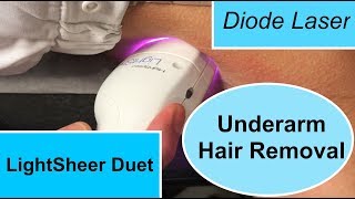 The LightSheer Duet Diode Laser for Underarm Hair Removal [upl. by Rosenkrantz]