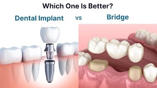 Dental Implant vs Bridge Which one is better to replace a missing tooth [upl. by Aihtniroc]