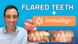 Invisalign Magic to Fix Flared Teeth WITHOUT EXTRACTION by Dr Robert Passamano [upl. by Taddeusz]