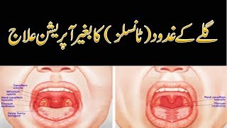 Homeopathic Treatment For Tonsils By Dr Naveed  Tonsil Ka Gharelu ilaj [upl. by Hassi688]