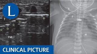 Pneumomediastinum in the neonate [upl. by Nauj]