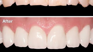 Composite Veneers Technique  Part1 [upl. by Jovitah736]