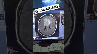 MRI Brain contrast Case Glioma GBMmri brain tumor GBM [upl. by Oriole317]