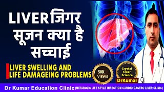 LIVER SWELLING CAUSES AND TREATMENT  Dr Kumar education clinic [upl. by Stargell]