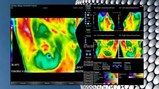 Anthony Thermography Software [upl. by Ahsias407]