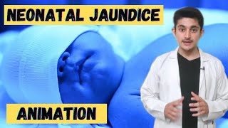 neonatal jaundice 3d animation  causes symptoms treatment  phototherapy for new born baby jaundice [upl. by Annissa]