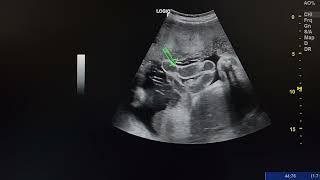 ultrasound case shows a fetus with gastroschisis [upl. by Meng]