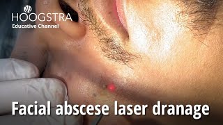 Facial abscese laser dranage  24152 [upl. by Bail793]