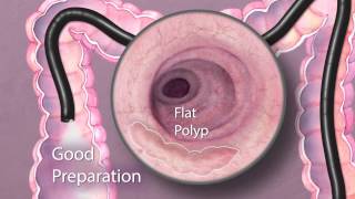 The Importance of Good Bowel Preparation During Colonoscopy [upl. by Anaejer]