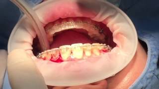 MOPSY Drill for Quick Orthodontics [upl. by Faubert87]