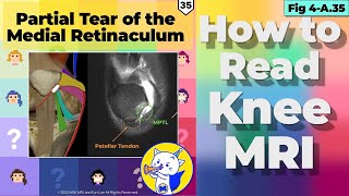 Fig 4A35 Partial Tear of the Medial Retinaculum [upl. by Aidualk]