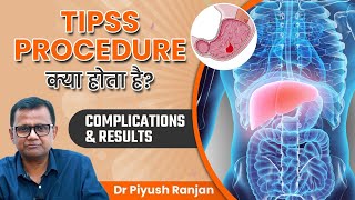 TIPSS Procedure क्या होता है  TIPS Complications and Results  Dr Piyush Ranjan [upl. by Pacifica]