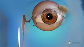 What is endoscopic dacryocystorhinostomy DCR surgery for blocked tear ducts [upl. by Cheshire517]