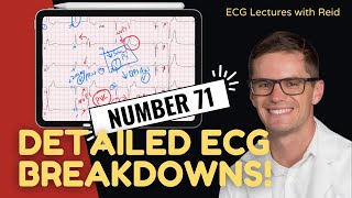 EKG Test Yourself  ECG Case Study 71 [upl. by Howund181]