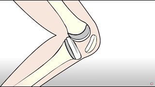 Knee Replacement vs Regenexx Orthopedic Regenerative Treatment [upl. by Cathe]