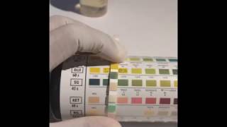 UTI dipstick test Urine Analysis [upl. by Adian]