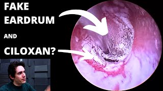 Fake Eardrum And Medication Residue Suction Ciloxan Or Cilodex [upl. by Lanam]