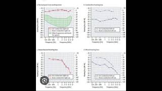 Audiogram Interpretation [upl. by Idou]