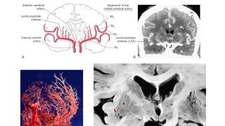 The lenticulostriate vessels and lacunar infarcts [upl. by Earased]