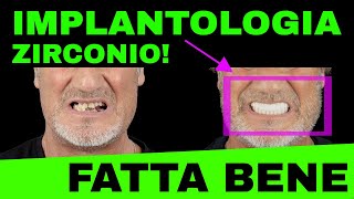 Implantologia Fatta Bene denti fissi in zirconio [upl. by Aenel730]