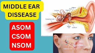 middle ear disease asom csom suppurative Otitis media ent neetpg [upl. by Amarillas]