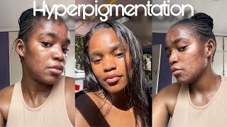 How to get rid of hyperpigmentation amp acne breakouts using benzoyl peroxide  active ingredients [upl. by Froh467]