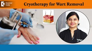 How to freeze and remove warts  Wart Removal Using Cryotherapy  Dr Amee Daxini  Doctors Circle [upl. by Columbine]